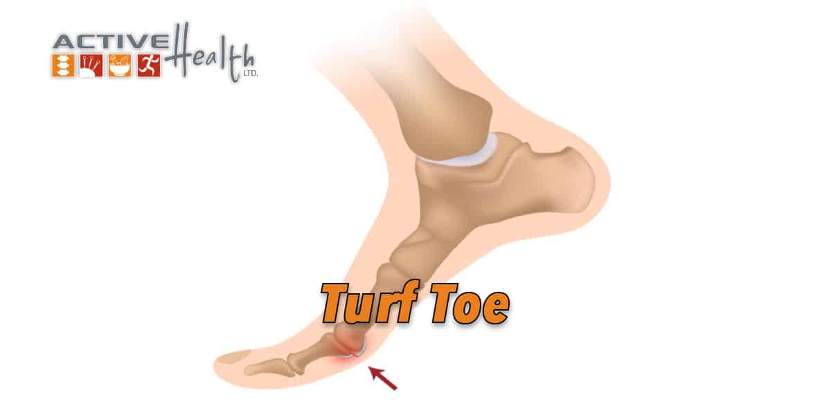 Condition of the Month (Turf Toe) Chiropractor Park Ridge, IL Active Health