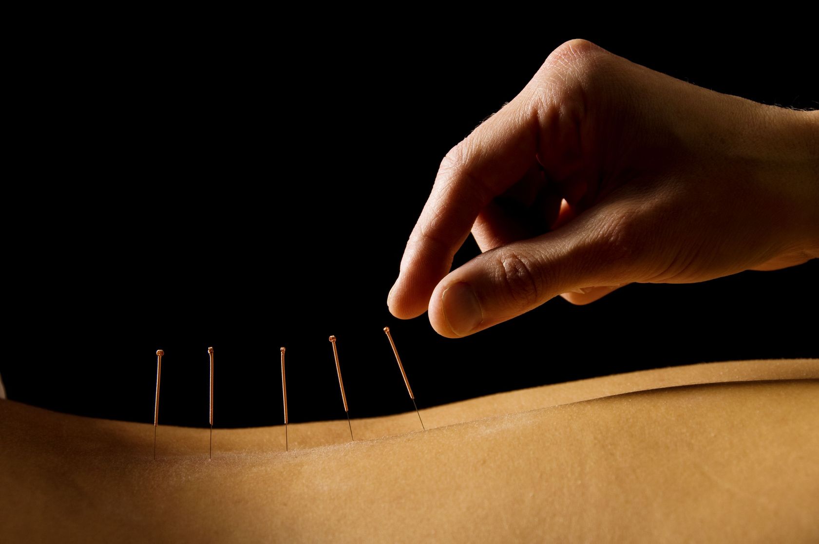 Conditions Treated with Acupuncture