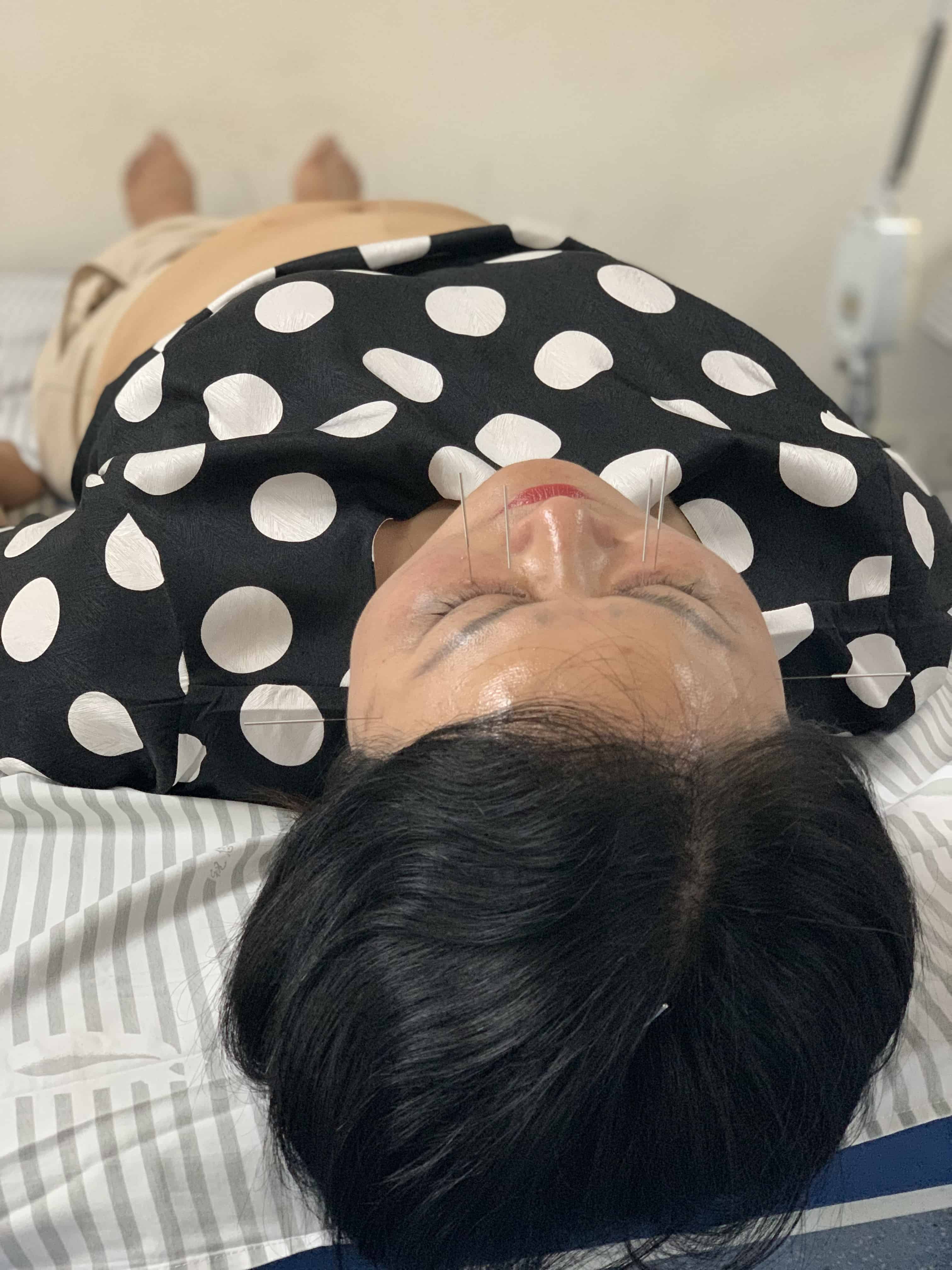 Can Acupuncture Help Fertility? Acupuncture Zen in Delray Beach