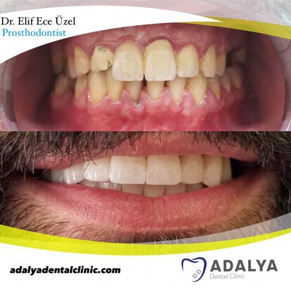 Dentistry Turkey Cosmetic Dentistry Antalya Adalya Dental Clinic