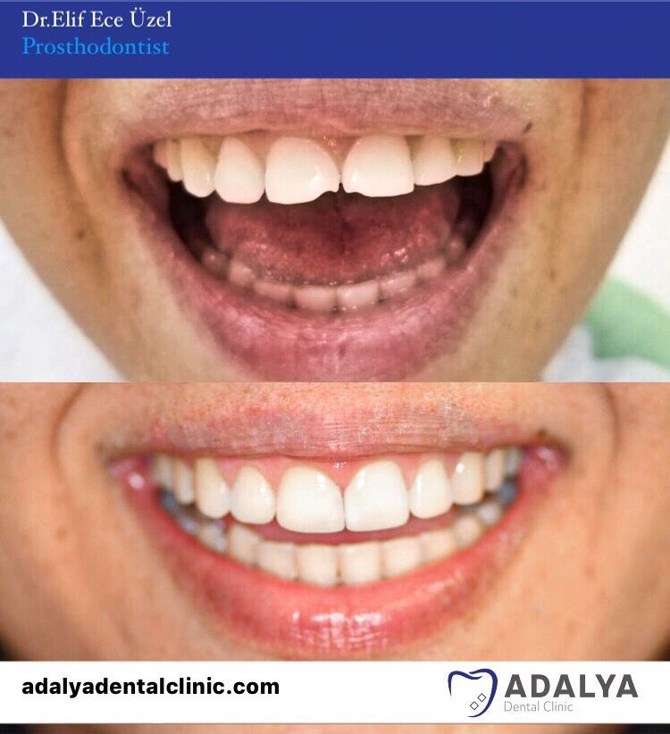 Dentistry Turkey Cosmetic Dentistry Antalya Adalya Dental Clinic