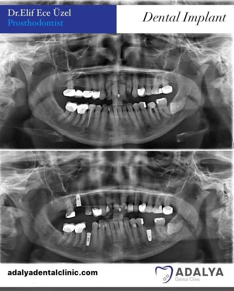 Dentistry Turkey Cosmetic Dentistry Antalya Adalya Dental Clinic
