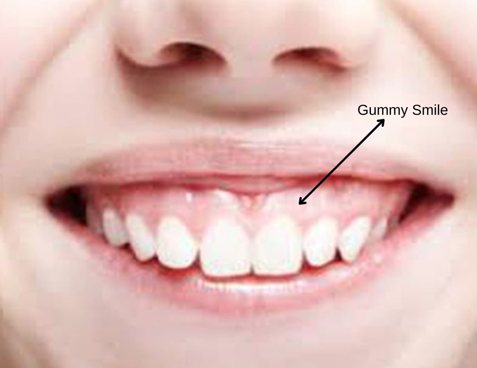 Gum Contouring in Turkey Gummy Smile Correction, Cost, Procedures