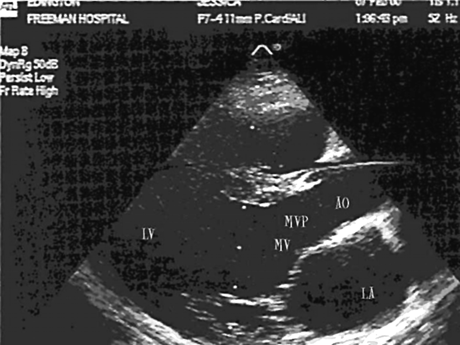 Leaking Mitral Valve