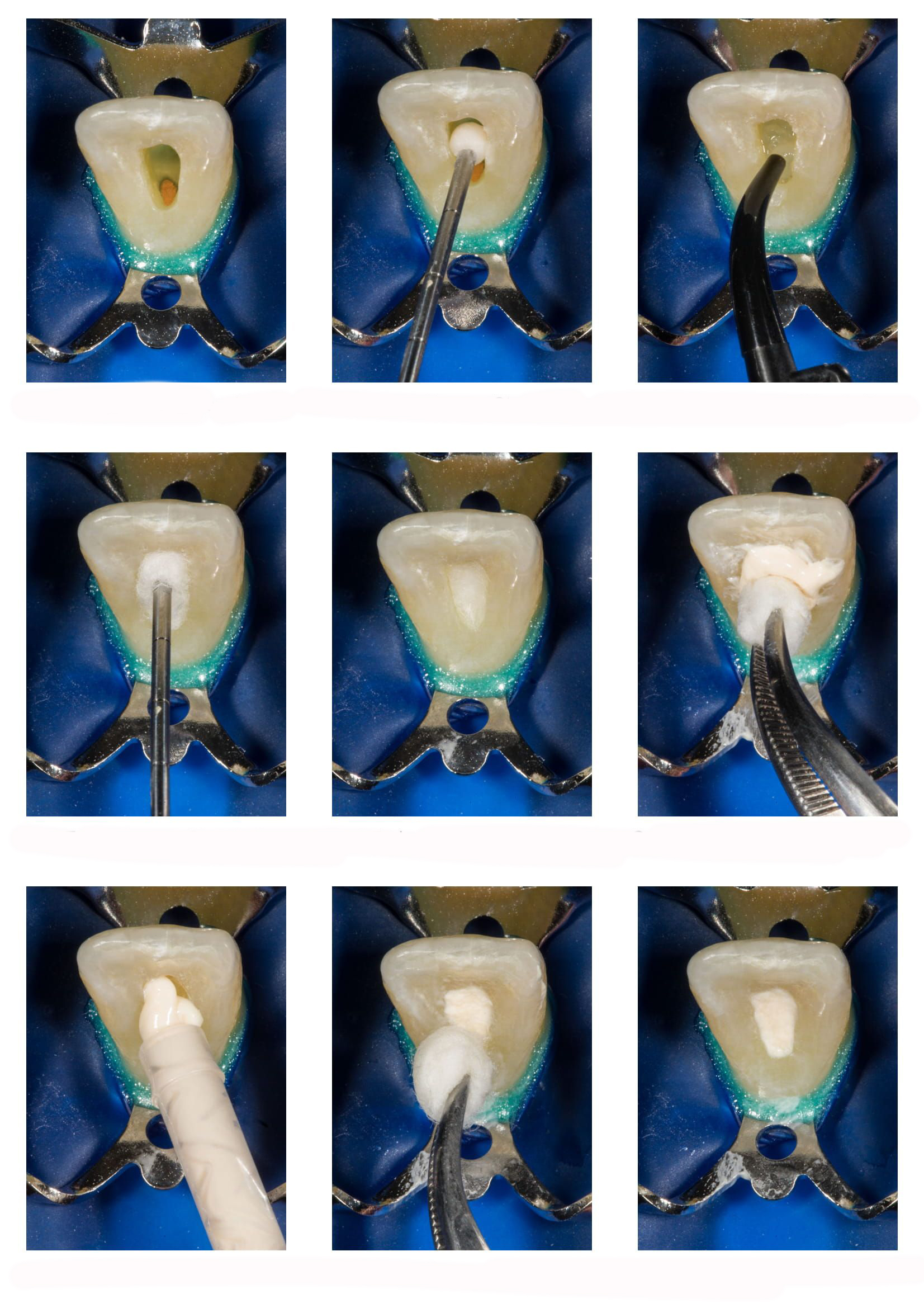 Opalescence™ Endo ADC