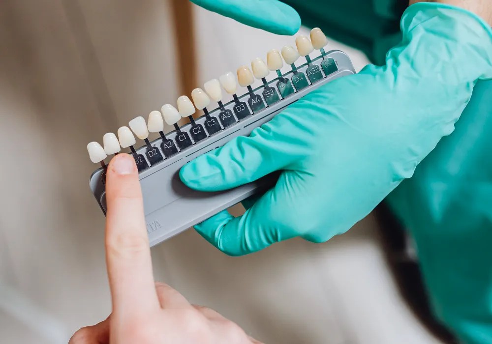 Dental Bonding ADCO Dental