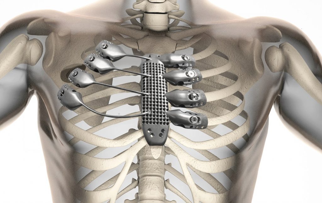 World's First 3D Printed Rib Cage Reconstruction Additive3D Asia
