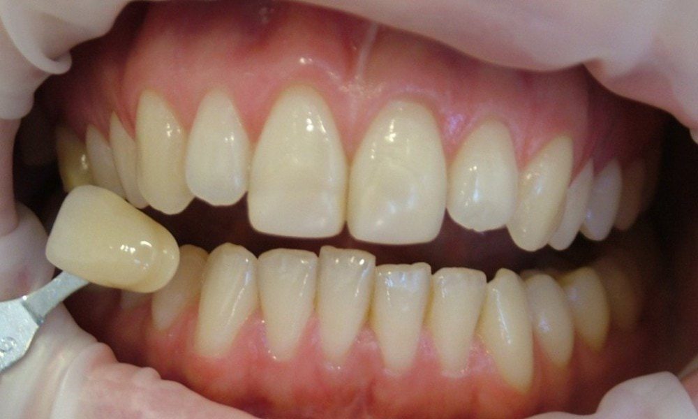 Teeth Whitening in Adelaide Adelaide Cosmetic Dentistry