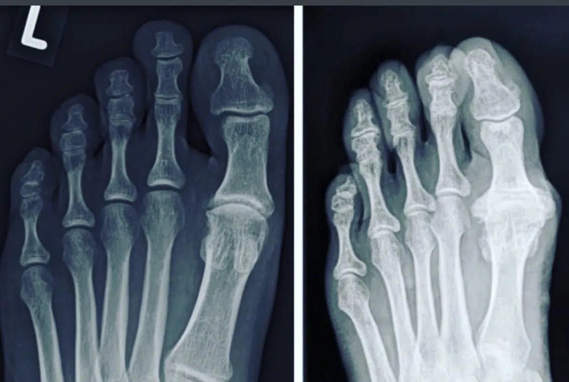 Hallux Rigidus Surgery Germany Dusseldorf Adem Erdogan