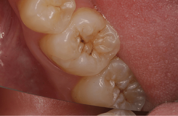 How To Know You Have A Cavity With Braces Awesome Article