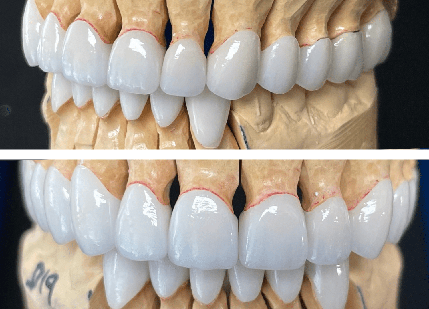 Full Mouth Reconstructions Toronto Dental Lab Dental Laboratory