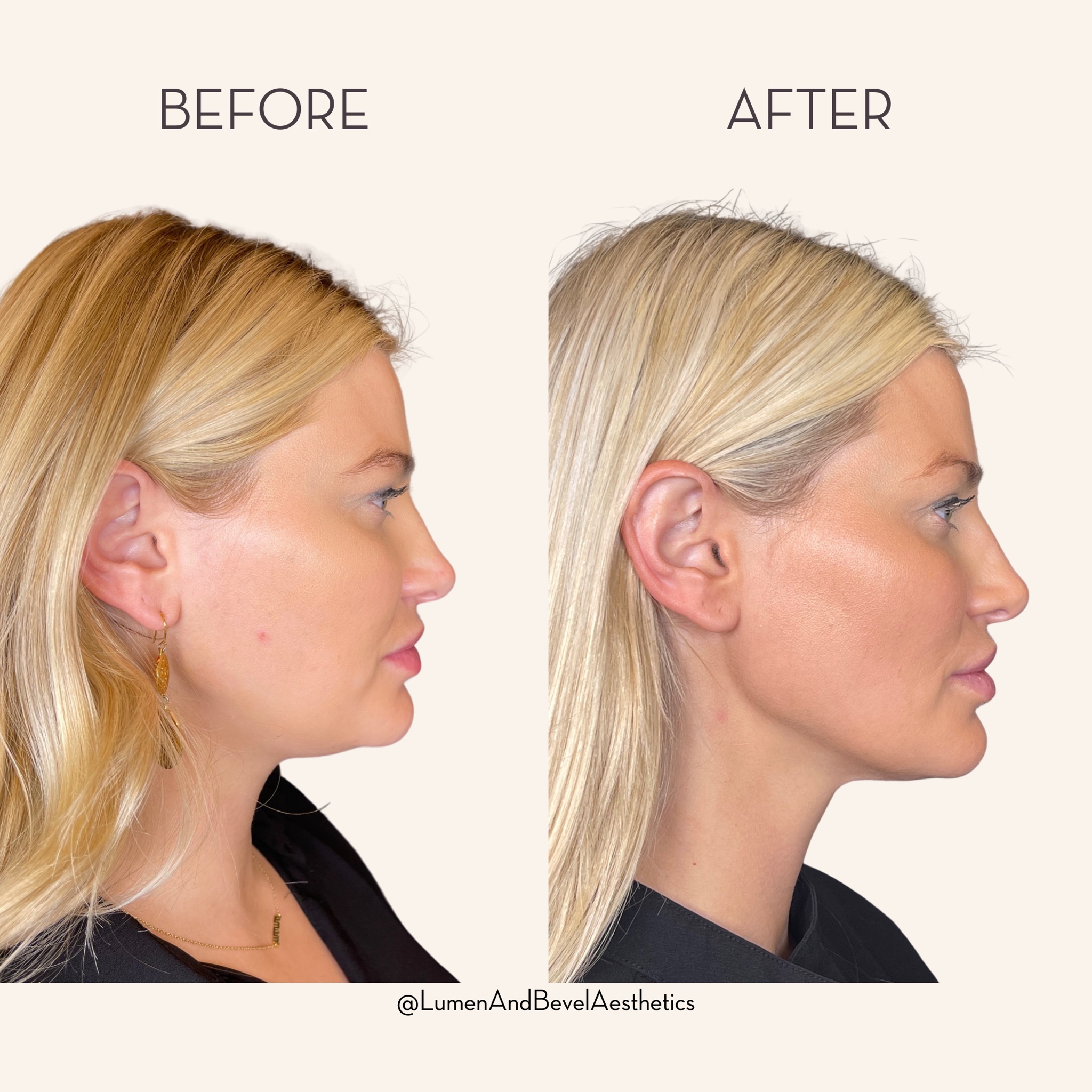 The Hourlift Nonsurgical facelift procedures can be done over