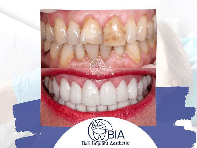 12 Veneers Bali Implant Aesthetic (BIA) Dental Center