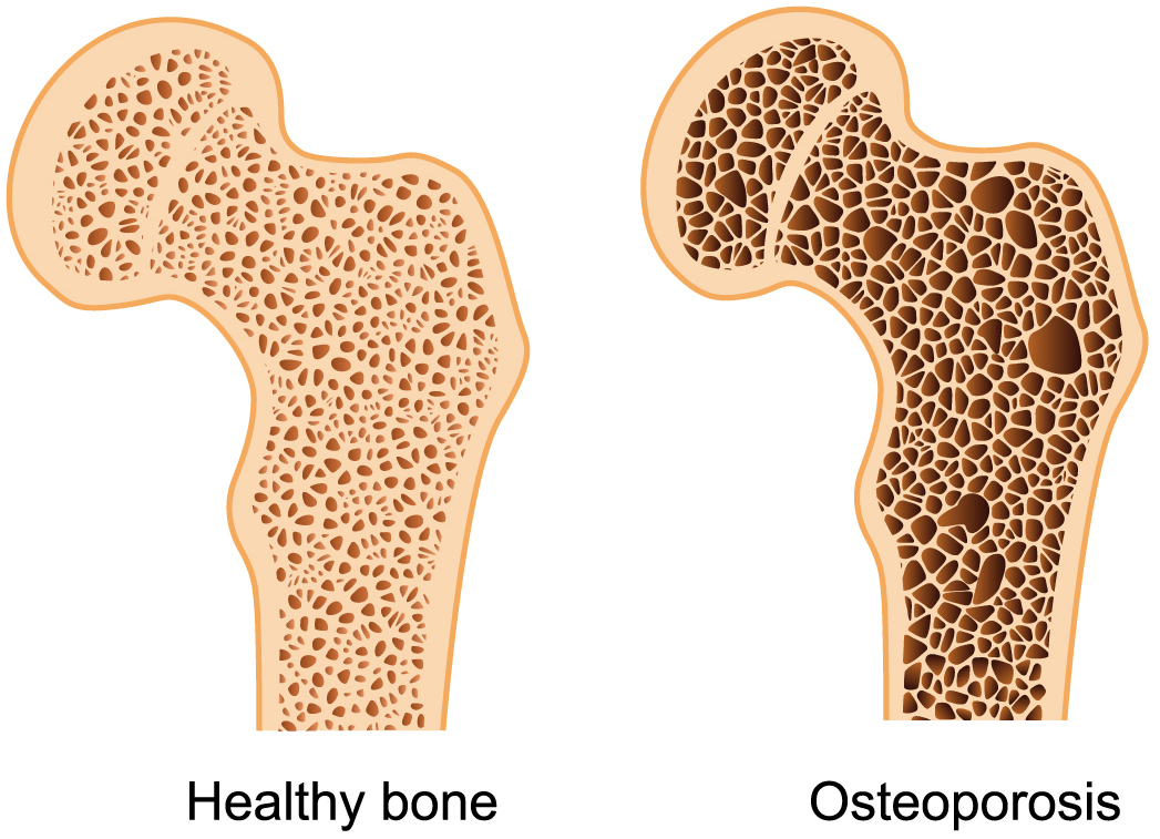 Osteoporosis in the Elderly LIDSEN Publishing Inc.丨The Open Access