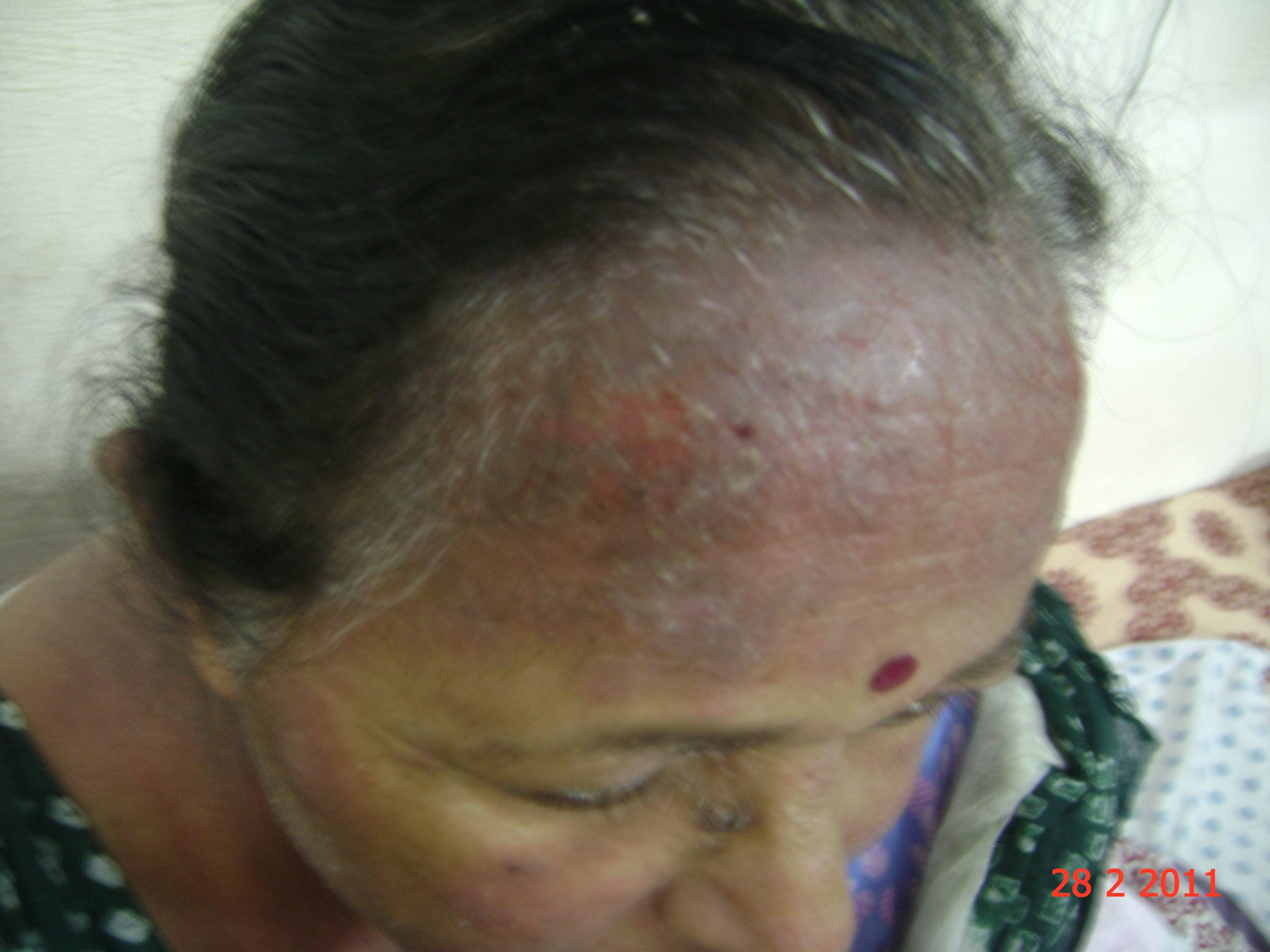 Photodermatitis Case Sunburn, Allergy, Rashes, Eruptions cured with