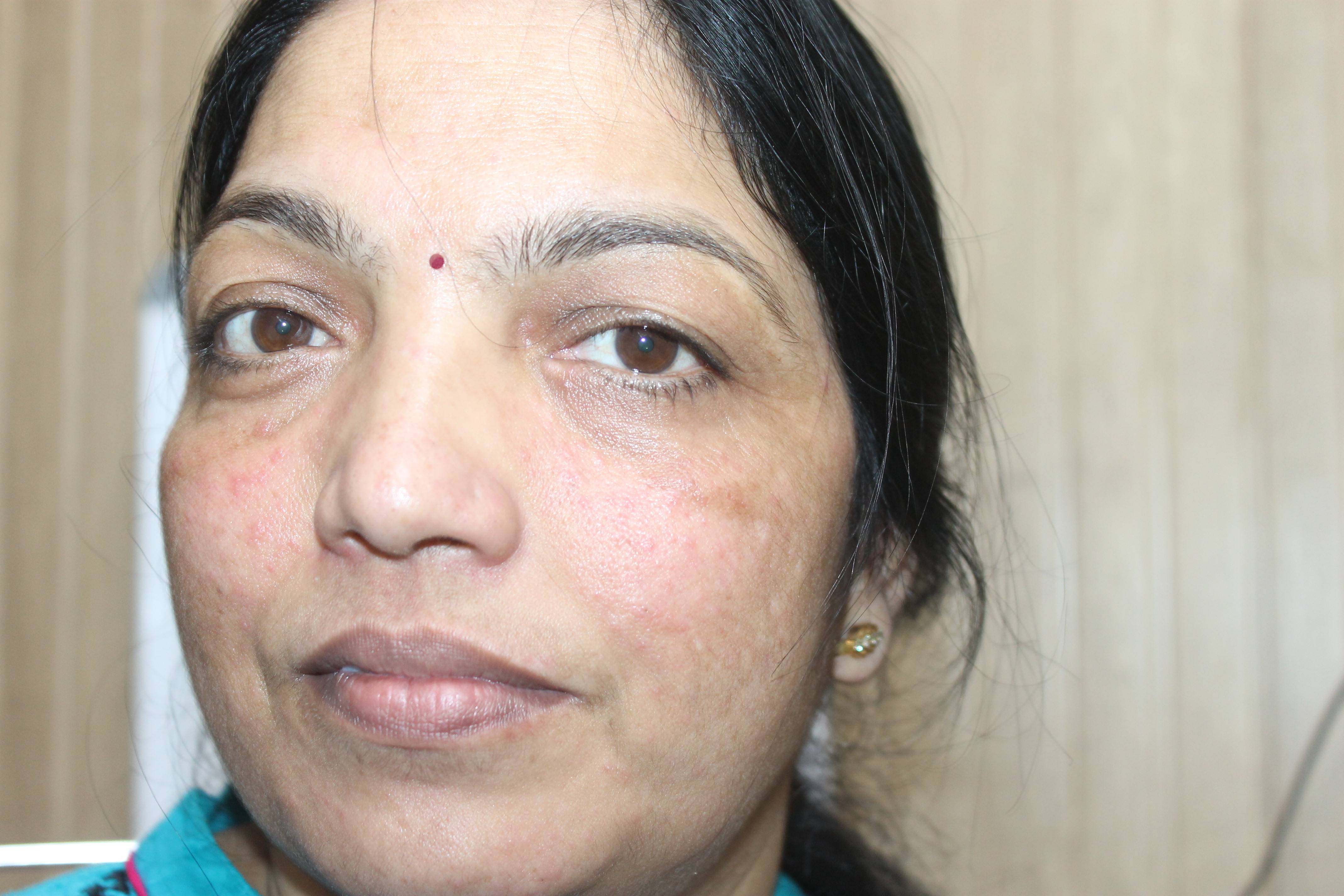 Rosacea, Acne & UTI cured completely with homeopathy Case Study
