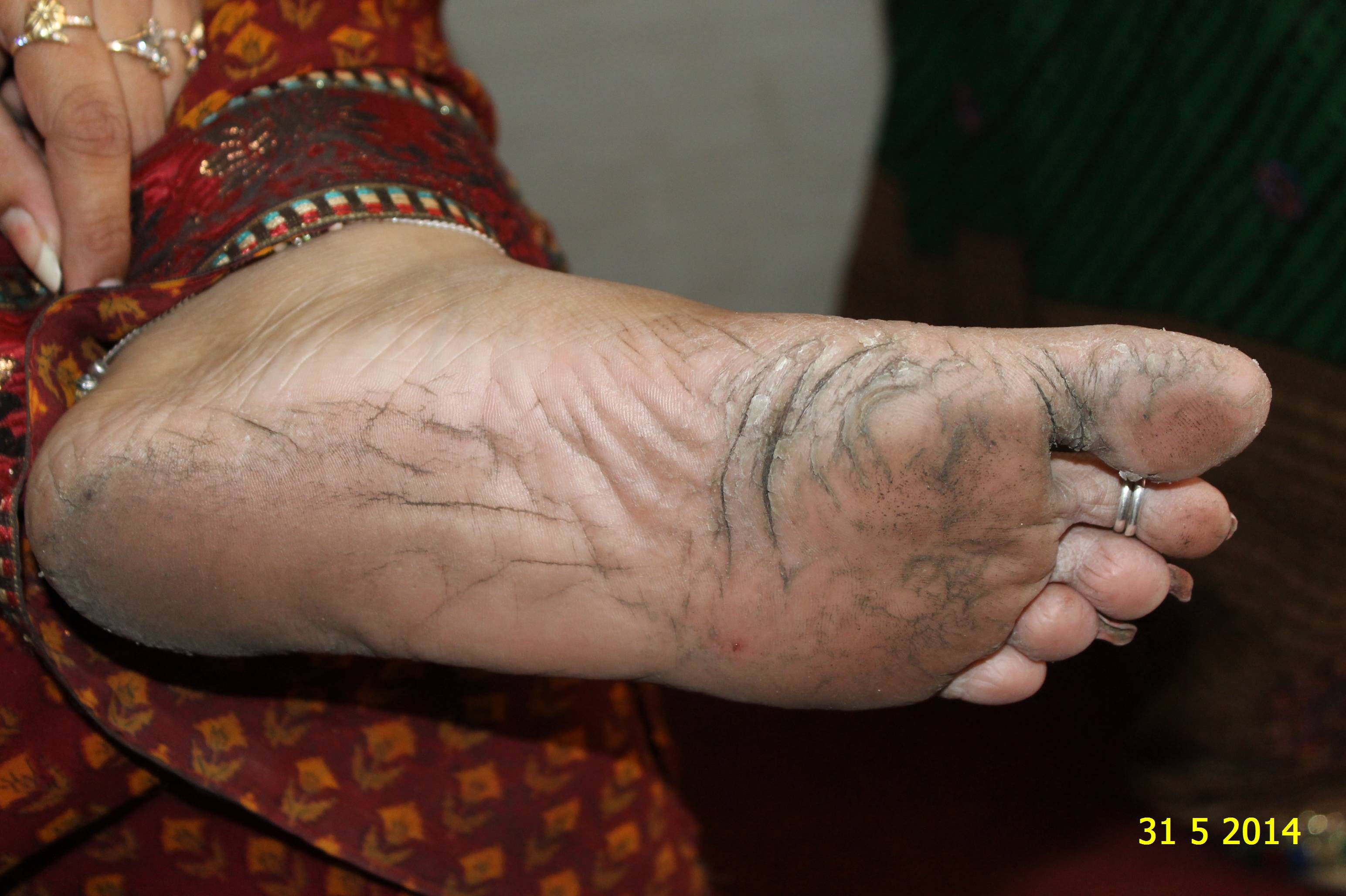 Foot Fissure Treatment