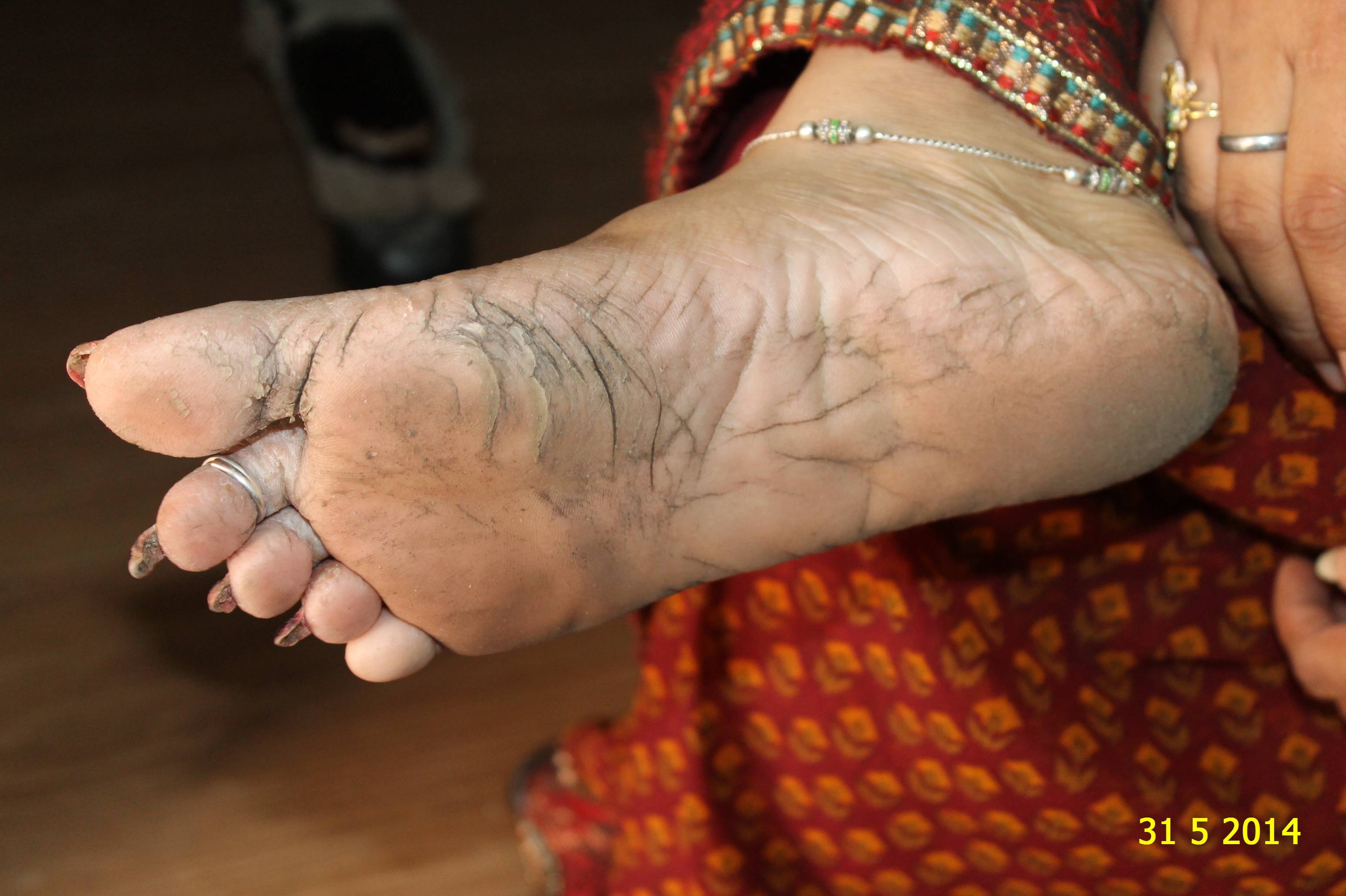 Cracked Feet or Heel Fissure Cured by Homoeopathy Case Study