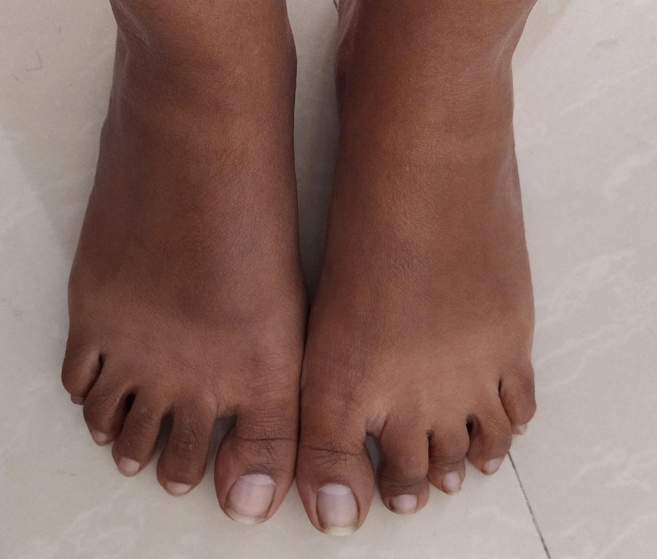 My feet are so dark & I got them tanned since 1 year due to my sandals