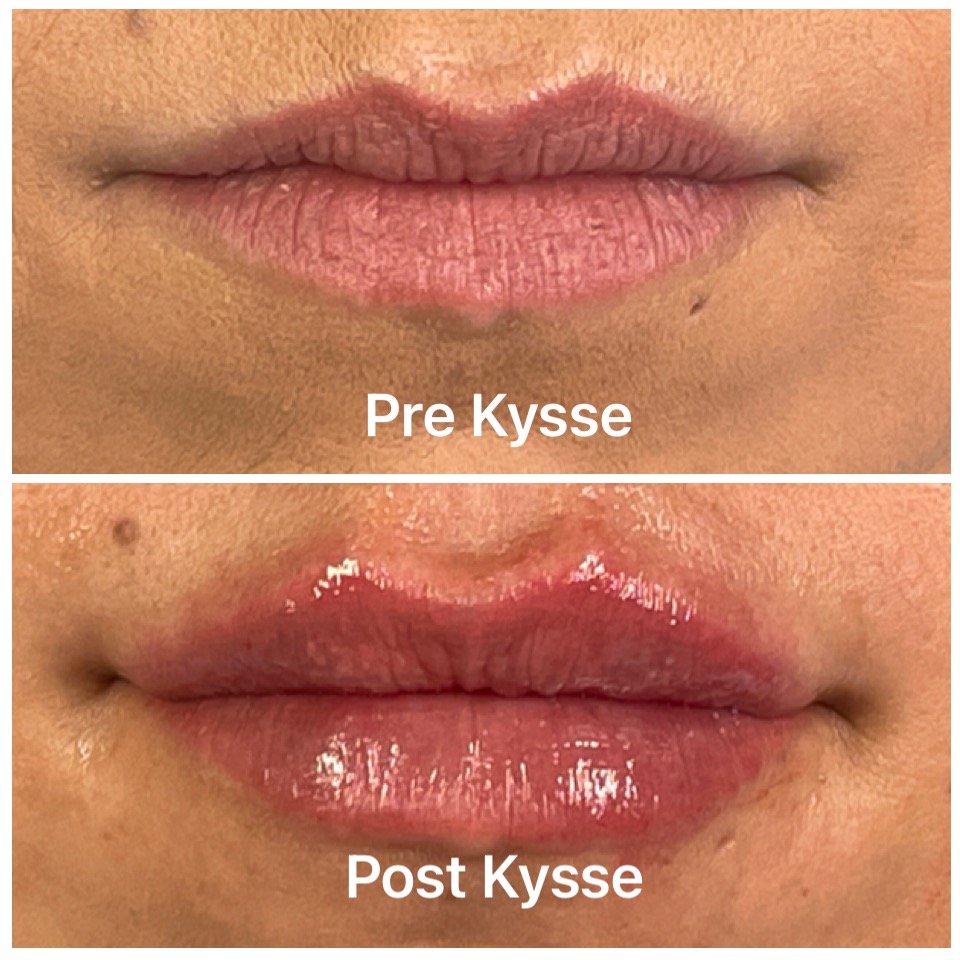Restylane Fillers Adore Aesthetix
