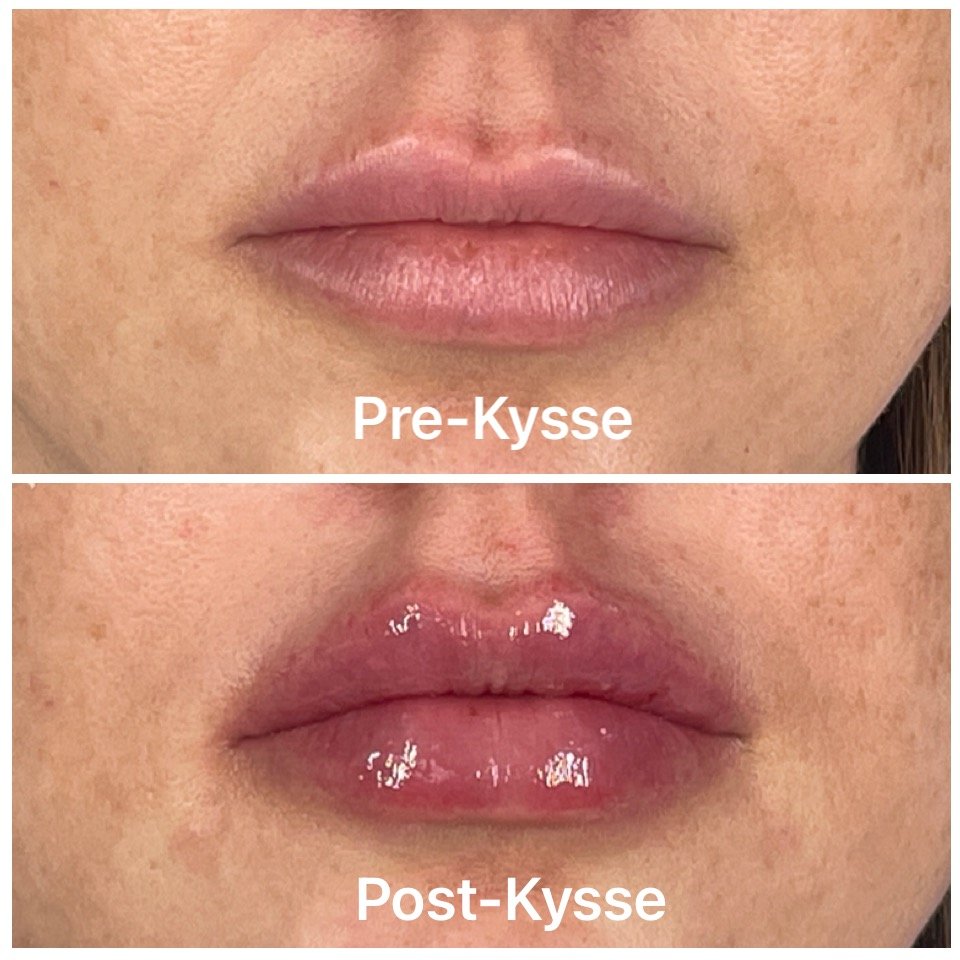 Restylane Fillers Adore Aesthetix