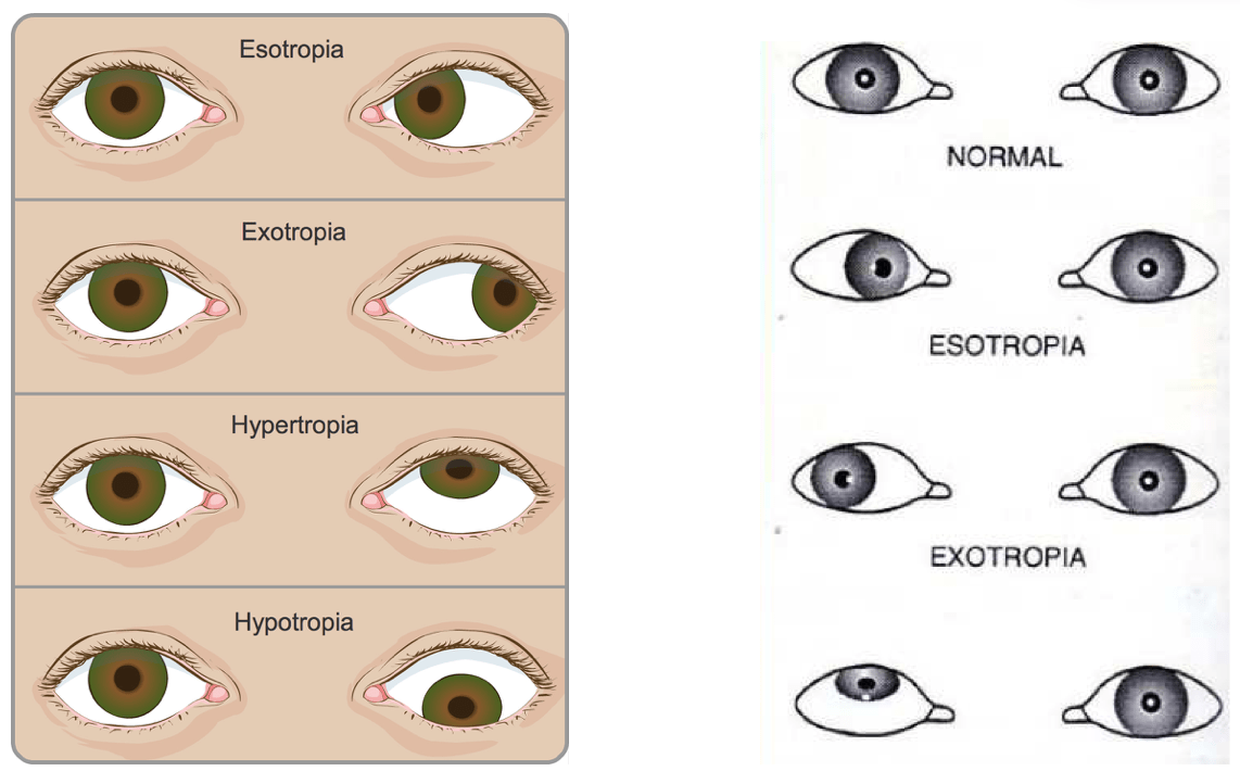 Strabismus (Squint) Singapore Causes & Treatment Options