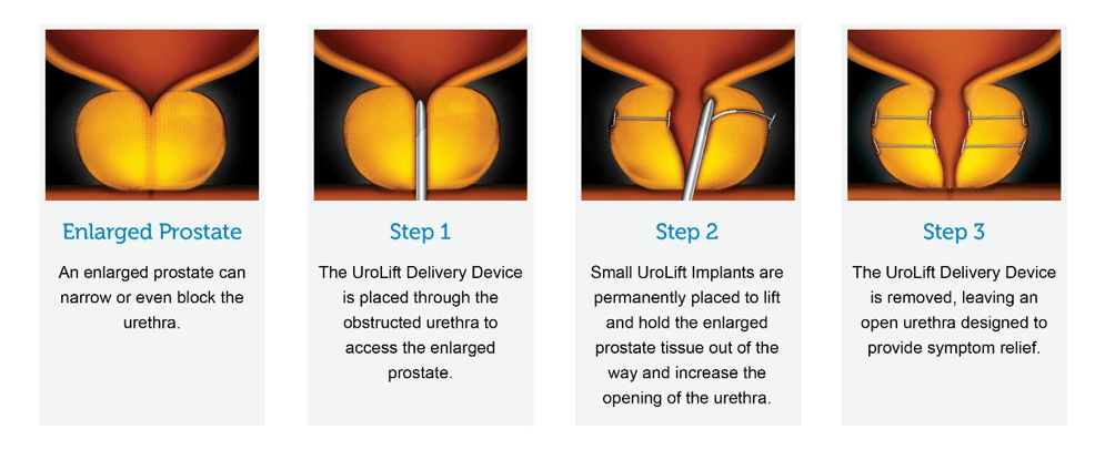 What is BPH? Adult & Pediatric Urology Omaha & Council Bluffs