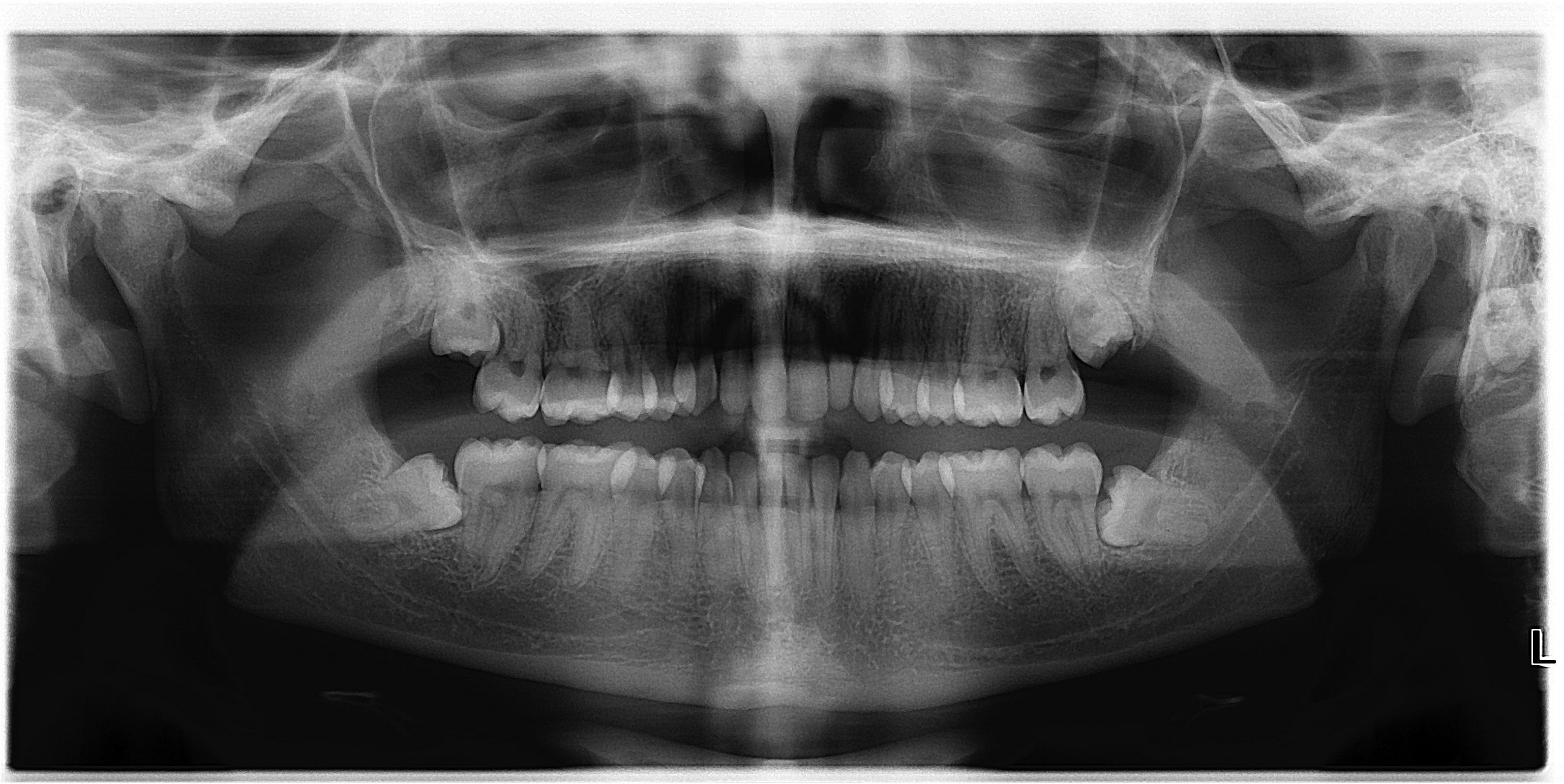 WISDOM TEETH Advance Cosmetic & General Dentistry
