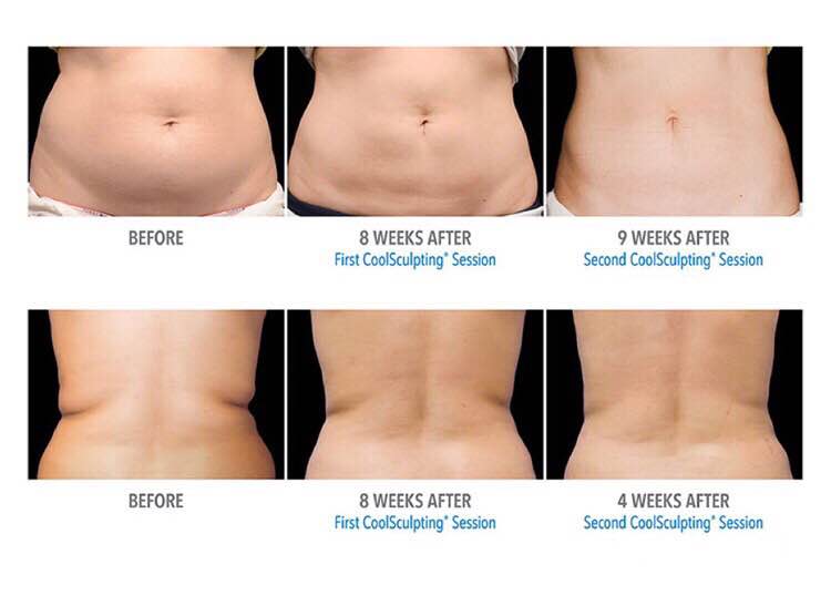 Coolsculpting Las Vegas Freeze Fat Las Vegas
