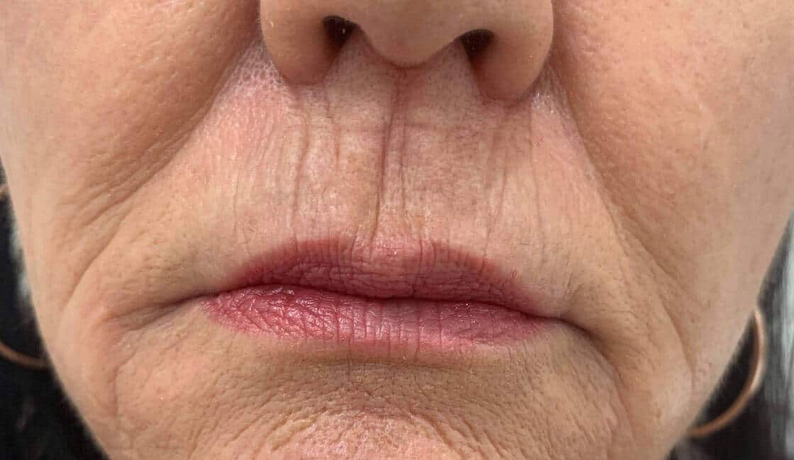 Lip Lines Treatment Adelaide Advanced Cosmetic Medicine