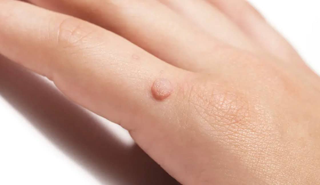 Expert Wart Removal Services in Adelaide Safe and Effective Treatments
