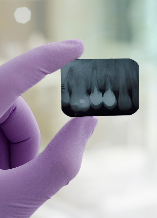 Root Canal Retreatment Endodontists in Richland & Walla Walla WA