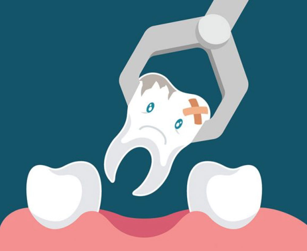 Extractions AdVance Dental PC Dentist Birmingham AL