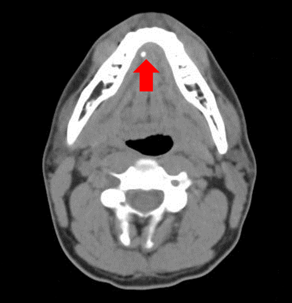 Salivary Gland Stones Atlanta Advanced ENT & Allergy Sinus Sleep