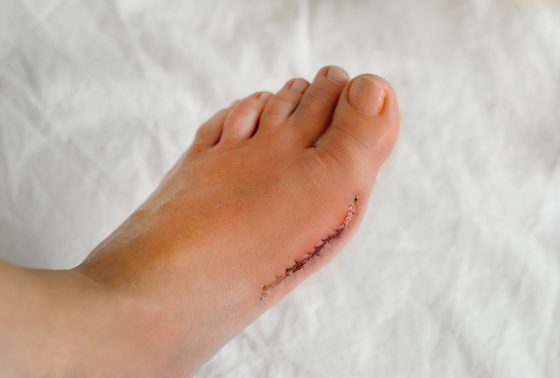 Treat Surgical Scars Podiatrist on Long Island
