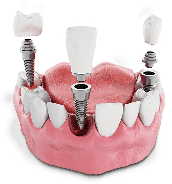 Dental Implant Cost Louisville, KY Advanced Implant Centers