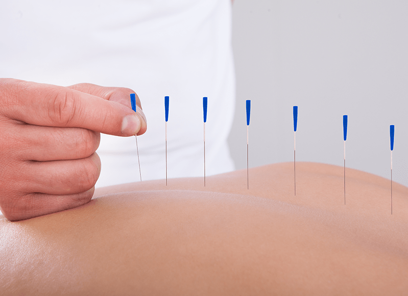 Why You Should Try Dry Needling Therapy Advanced Manual