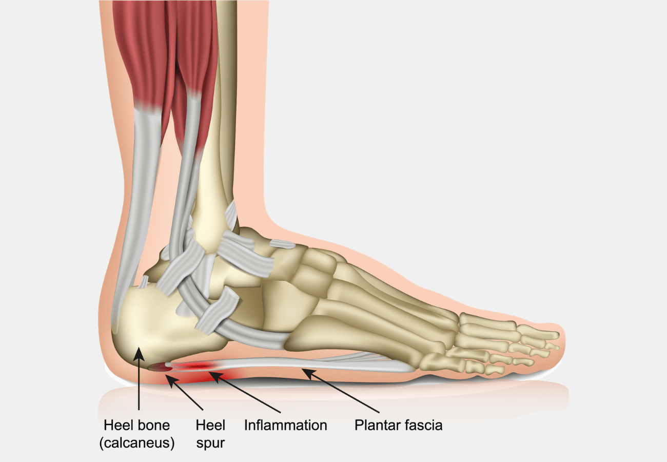 EPAT for Plantar Fasciitis (Heel Pain) Advanced Ortho and Spine