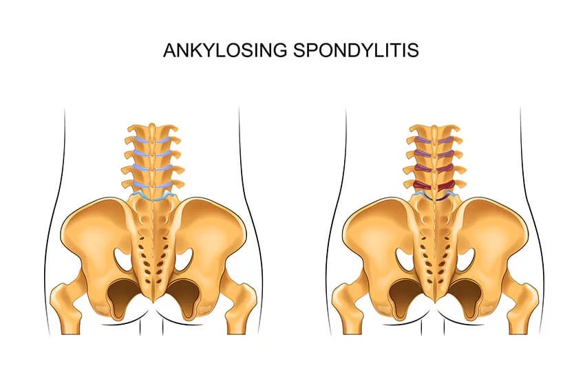 Ankylosing Spondylitis Ankylosing Spondylitis Treatment in Hyd