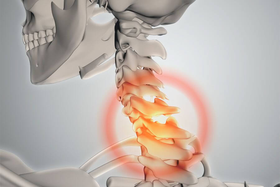 Hernia discal cervical ¿hay que operarse? Advansur Traumatología
