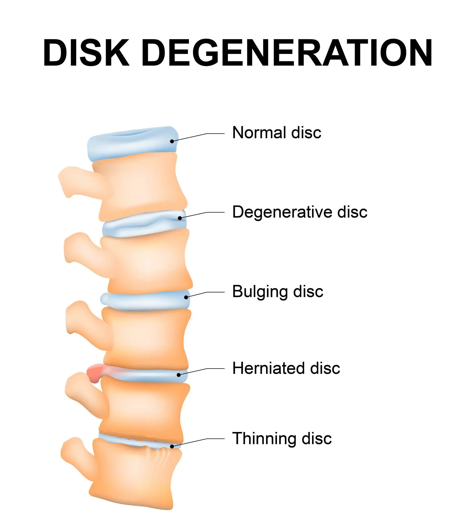 Disc Degeneration Advanced Chirporactic & Rehab, Inc.