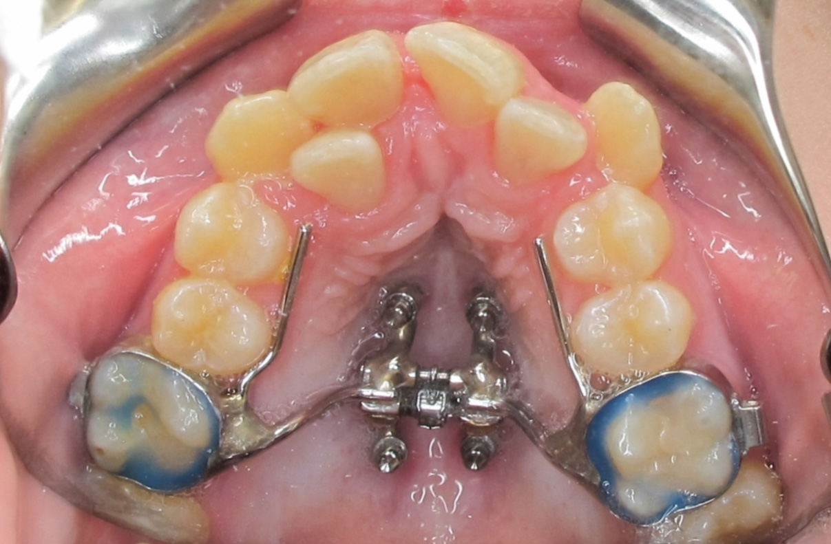 Maxillary Skeletal Expansion Adventure Orthodontics