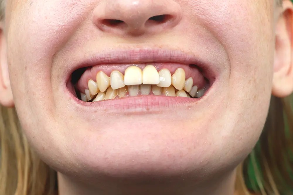 Tooth implant rejection what it is, symptoms and causes