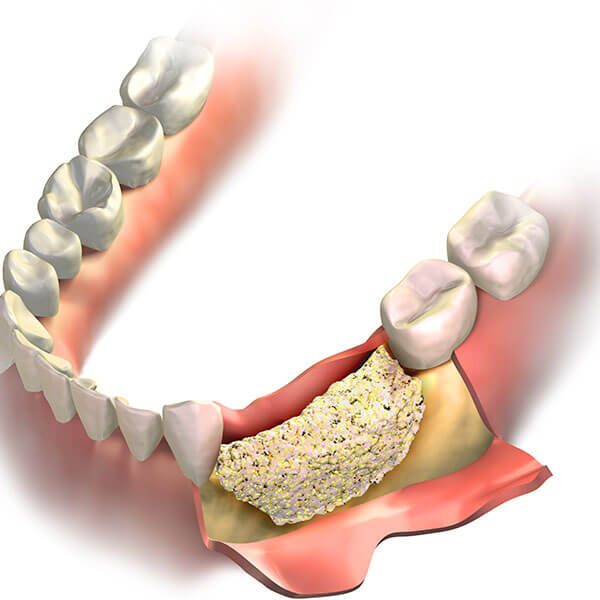 Dental Bone Graft in Fort Lauderdale, FL tooth bone graft cost