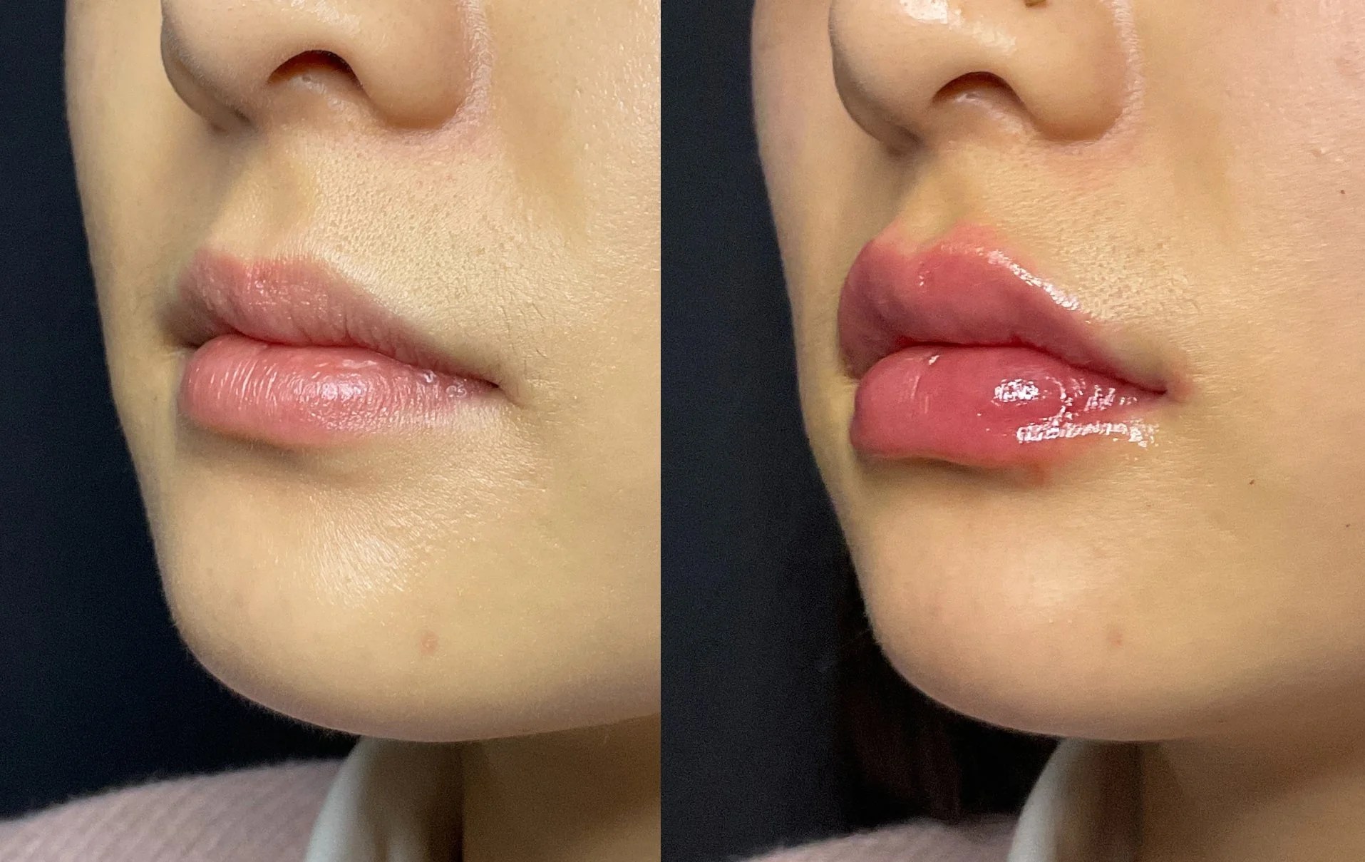 CHERRY LIPS KOREA’S LATEST LIP FILLER TREND AE.R Skinlab