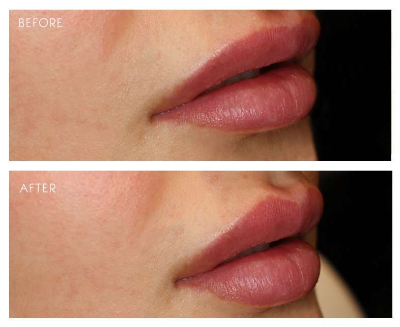 The Cupid’s Bow Lip Treatment Aestha Clinic(05)