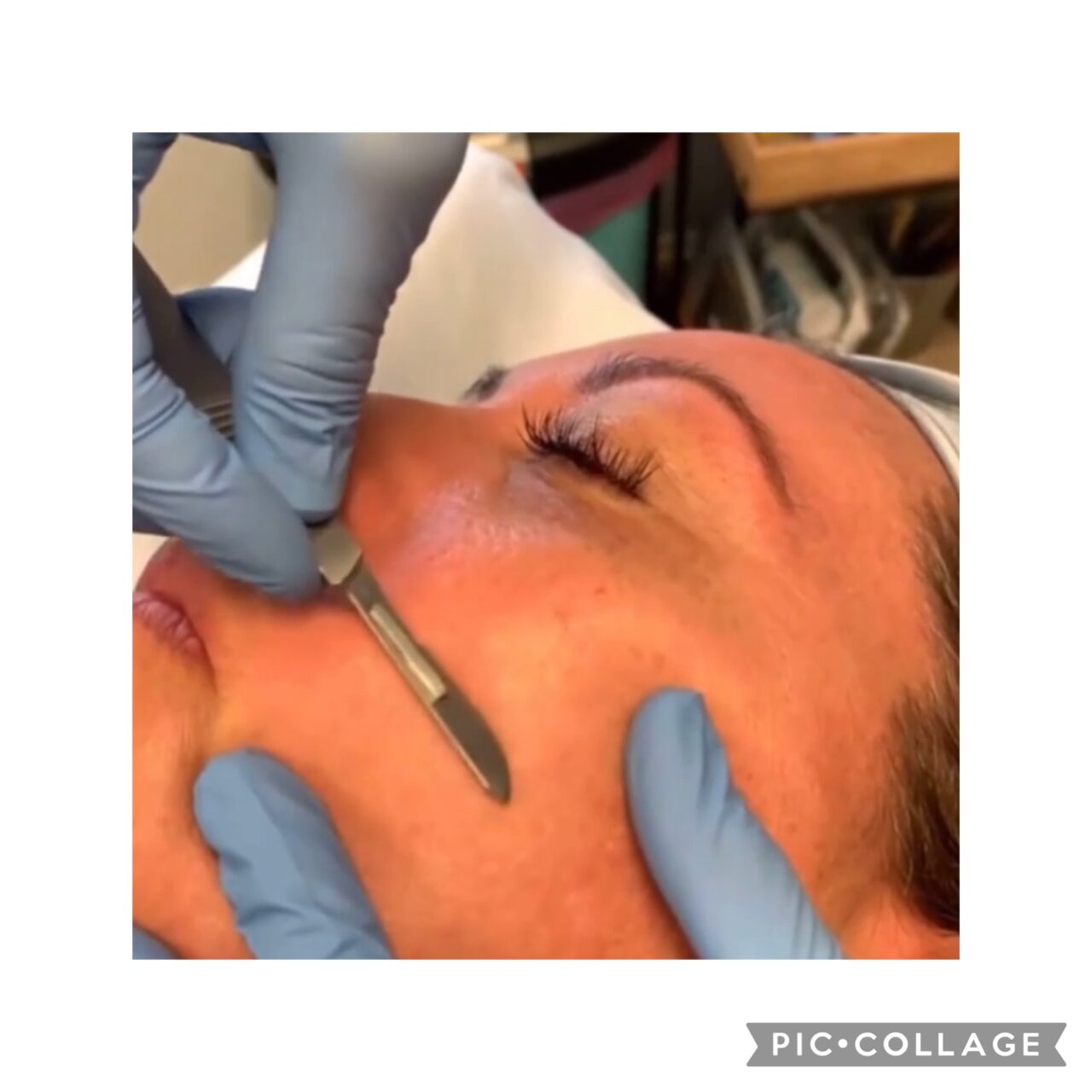 Dermaplaning Aesthetica