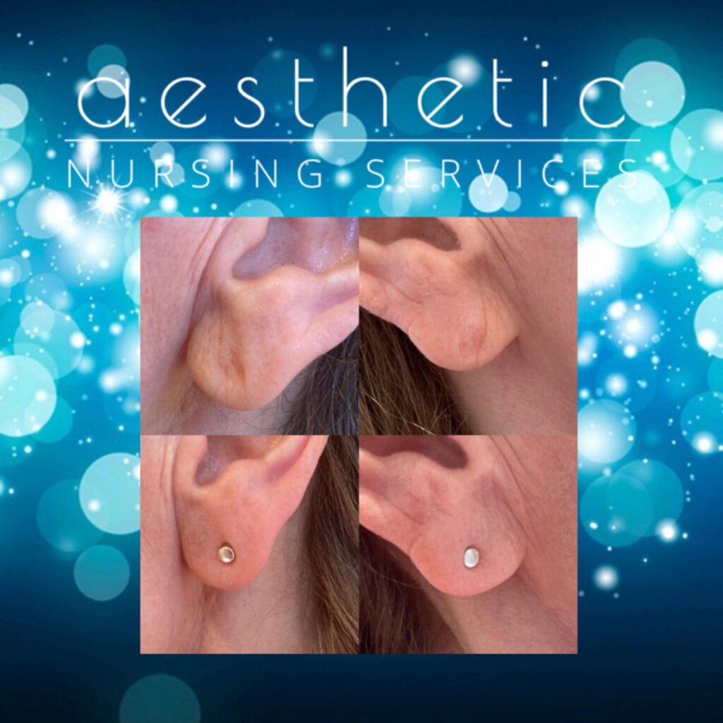 Ear Lobe Dermal Filler Treatment Before and After Aesthetic Nursing