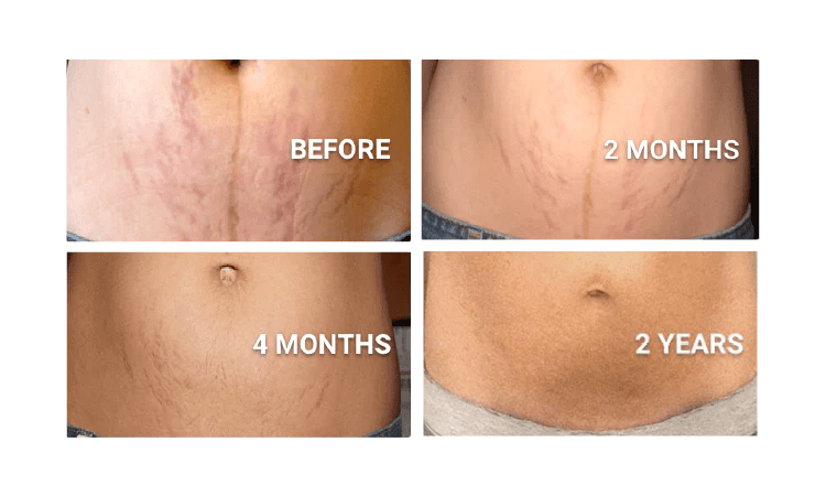 Effective Stretch Marks Treatments In Wagholi Aesthetic World Clinic