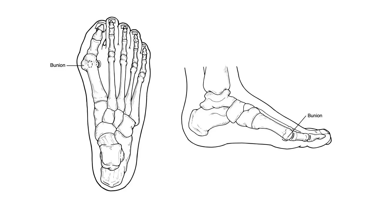 Bunions Allentown Family Foot Care